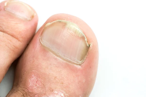 Крупный план псориаза вульгарис и грибок на ногах человека ногти — стоковое фото