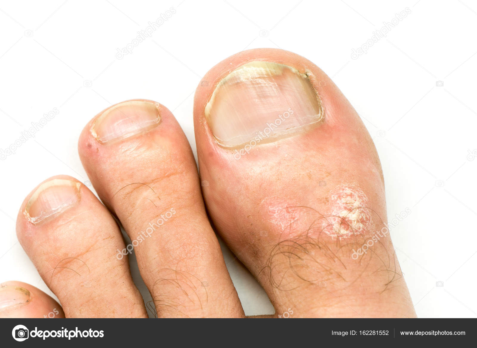 gomba skin hands nail foot a körömgomba pszichés oka