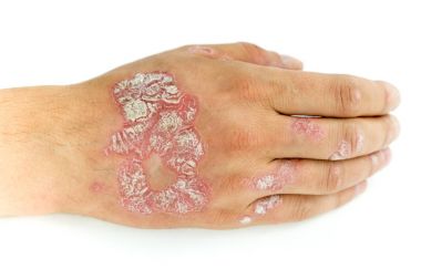 Psoriasis vulgaris ve mantar adam el ve parmak ile plak, döküntü ve yamalar, beyaz arka plan üzerinde izole. Otoimmün hastalığı genetik.