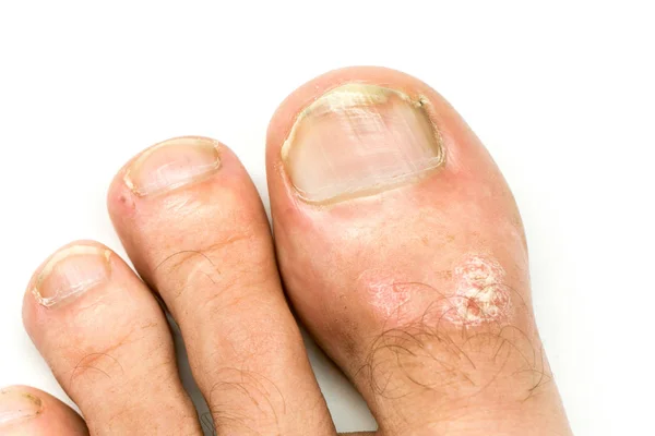 Closeup of Psoriasis vulgaris and fungus on the mans foot finger nails — Stock Photo, Image