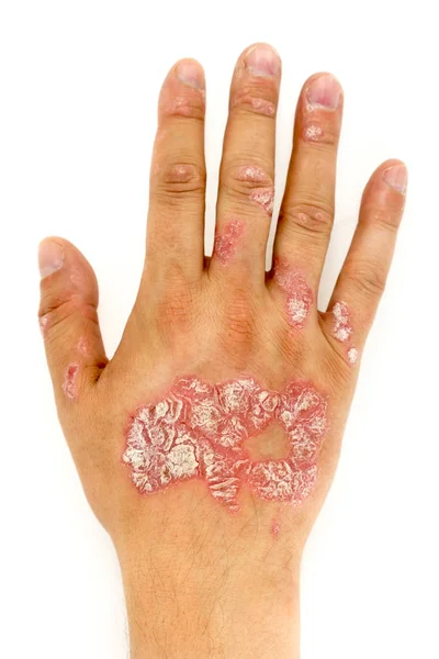 Psoriasis vulgar en la mano del hombre y las uñas de los dedos —  Fotos de Stock