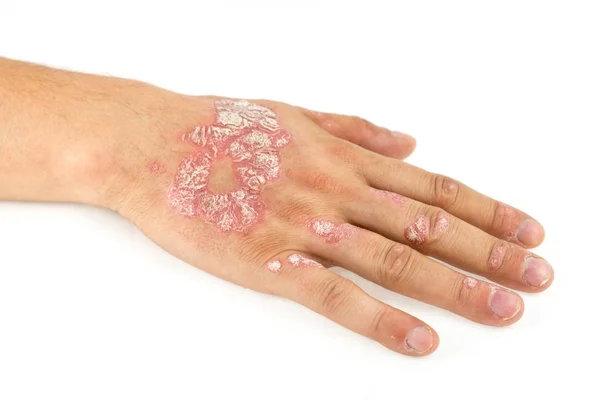 Psoriasis vulgar en la mano masculina y uñas de los dedos —  Fotos de Stock