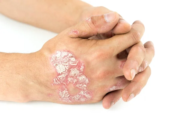 Psoriasis vulgaris op de mannelijke handen met plaque, de uitslag en de patches, geïsoleerd op een witte achtergrond. Genetische auto-immuunziekte. Rechtenvrije Stockfoto's