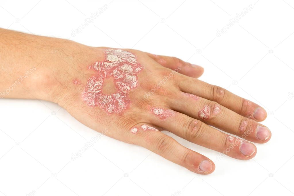 Psoriasis vulgaris on the male hand and finger nails