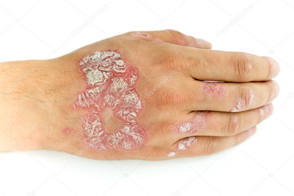 Psoriasis vulgaris and fungus on the man hand and fingers with plaque, rash and patches, isolated on white background. Autoimmune genetic disease.