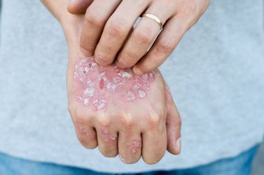 Adam kaşı kendini kuru lapa lapa cilt yandan psoriasis vulgaris, egzama ve mantar, plak, döküntü ve düzeltme ekleri gibi diğer cilt koşulları ile. Otoimmün hastalığı genetik.