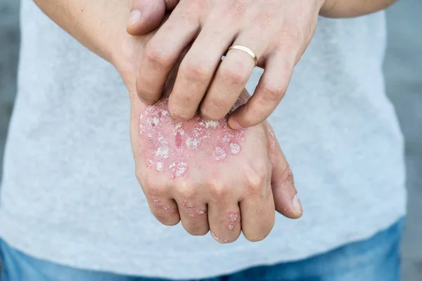 El hombre se rasca a sí mismo, la piel seca escamosa en la mano con psoriasis vulgar, eczema y otras condiciones de la piel como hongos, placa, erupción cutánea y parches. Enfermedad genética autoinmune . — Foto de Stock