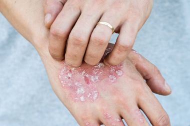 Adam kaşı kendini kuru lapa lapa cilt yandan psoriasis vulgaris, egzama ve mantar, plak, döküntü ve düzeltme ekleri gibi diğer cilt koşulları ile. Otoimmün hastalığı genetik.