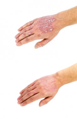 Psoriasis vulgaris yandan, beyaz arka plan üzerinde izole işlemden önce ve sonra. Portre.