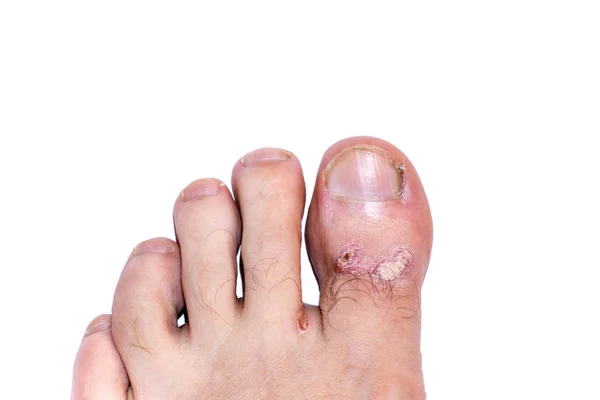 Torr Flagnande Hud Fot Och Med Psoriasis Vulgaris Eksem Och — Stockfoto