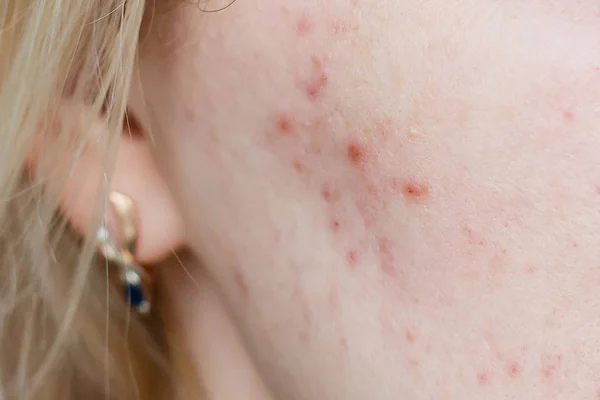 Close up photo of nodular cystic acne skin — Stock Photo, Image