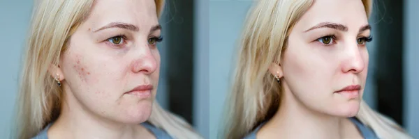 Mujer joven antes y después del tratamiento y el maquillaje . — Foto de Stock