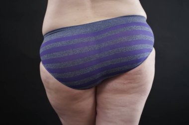 Kadın selülit derisi artı siyah stüdyo arka planında büyük kalçalar.