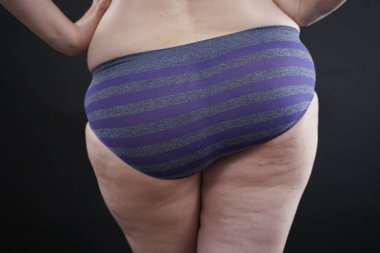 Kadın selülit derisi artı siyah stüdyo arka planında büyük kalçalar.