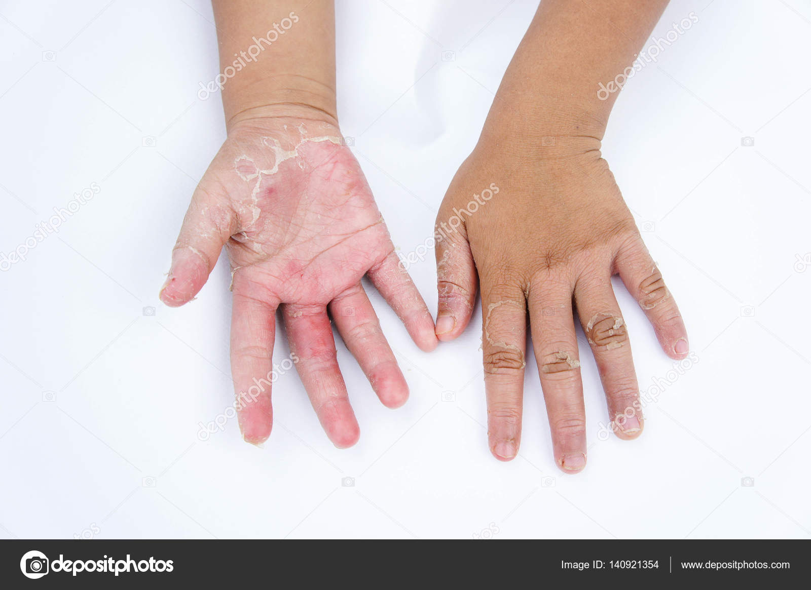 Dermatitis de contacto en manos y pies