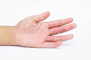 Kuru eller, kabuğu, Kontakt Dermatit, mantar enfeksiyonları