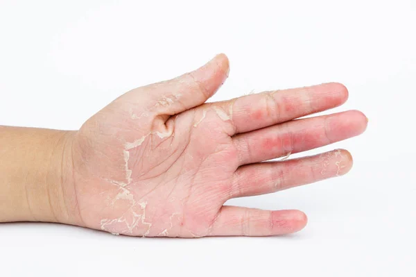 Droge Handen Peel Contactdermatitis Schimmelinfecties Huidinfecties Van Blootstelling — Stockfoto