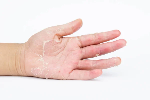 Dry hands, peel, Contact dermatitis, fungal infections — Stock Photo, Image