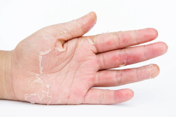 Mãos Secas Casca Dermatite Contacto Infecções Fúngicas Infecções Cutâneas Resultantes — Fotografia de Stock