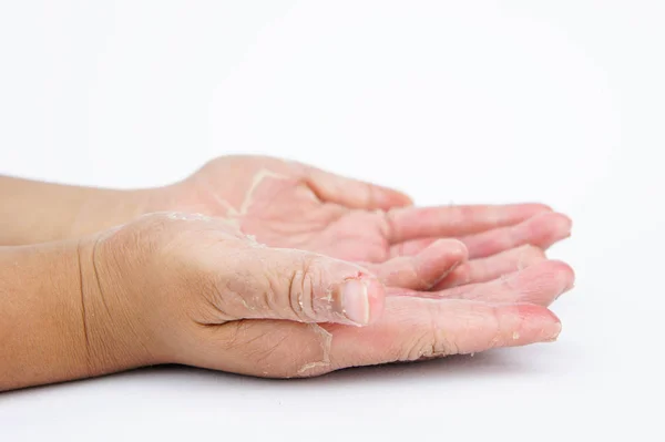 Mãos secas, casca, dermatite de contato, infecções fúngicas — Fotografia de Stock