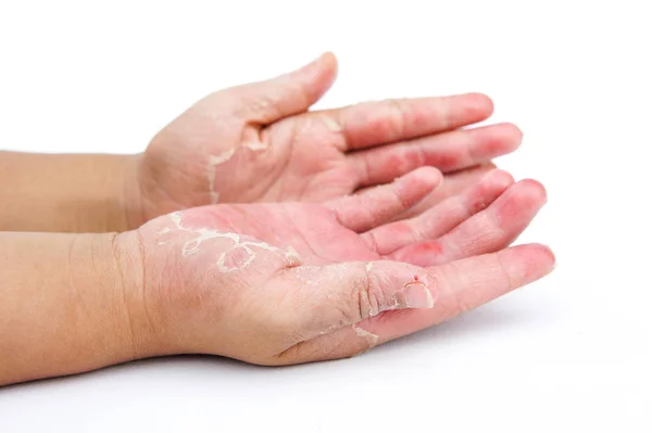 Mãos secas, casca, dermatite de contato, infecções fúngicas — Fotografia de Stock