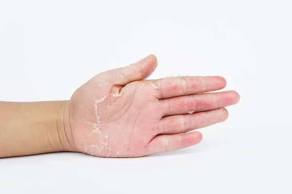 Droge handen, peel, contactdermatitis, schimmelinfecties — Stockfoto