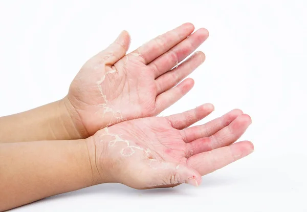 Kuru eller, kabuğu, Kontakt Dermatit, mantar enfeksiyonları