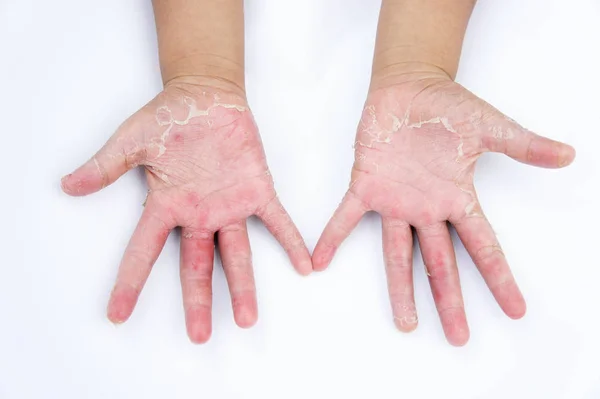 Droge handen, peel, contactdermatitis, schimmelinfecties — Stockfoto