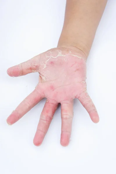 Ξηρά χέρια, φλούδα, δερματίτιδα εξ επαφής, μυκητιασικές λοιμώξεις — Φωτογραφία Αρχείου