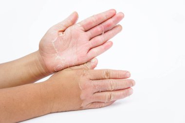 Kuru eller, kabuğu, Kontakt Dermatit, mantar enfeksiyonları, deri enfeksiyonları maruz kalma