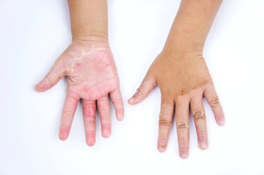 Kuru eller, kabuğu, Kontakt Dermatit, mantar enfeksiyonları, Cilt INF