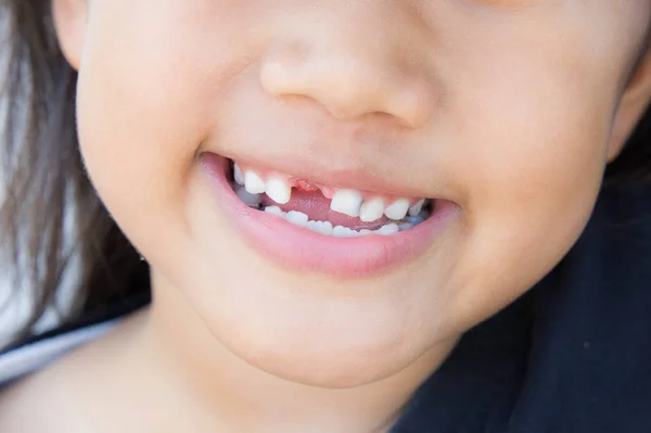 Asiatisches Mädchen lächelt gebrochenen Zahn — Stockfoto