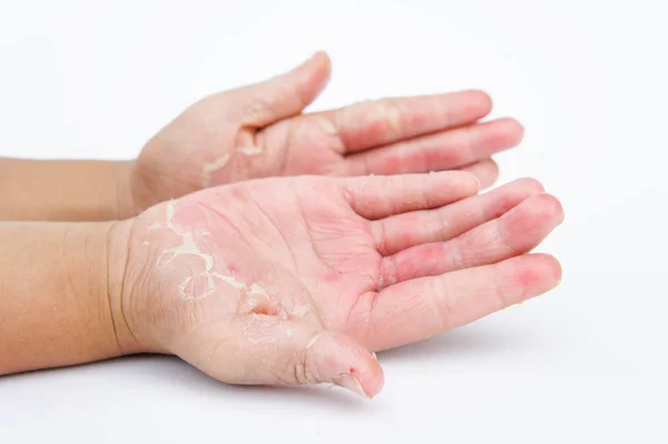 Droge Handen Peel Contactdermatitis Schimmelinfecties Huidinfecties Van Blootstelling — Stockfoto