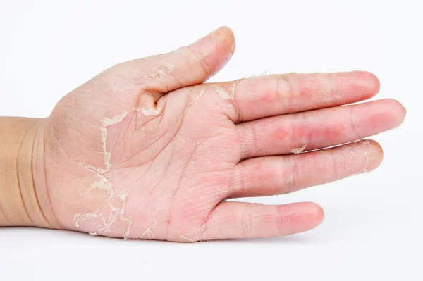 Droge Handen Peel Contactdermatitis Schimmelinfecties Huidinfecties Van Blootstelling — Stockfoto