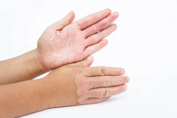 Droge Handen Peel Contactdermatitis Schimmelinfecties Huidinfecties Van Blootstelling — Stockfoto