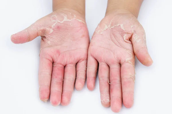 Mãos secas, casca, dermatite de contato, infecções fúngicas, pele inf — Fotografia de Stock