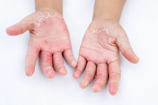 Mãos secas, casca, dermatite de contato, infecções fúngicas, pele inf — Fotografia de Stock