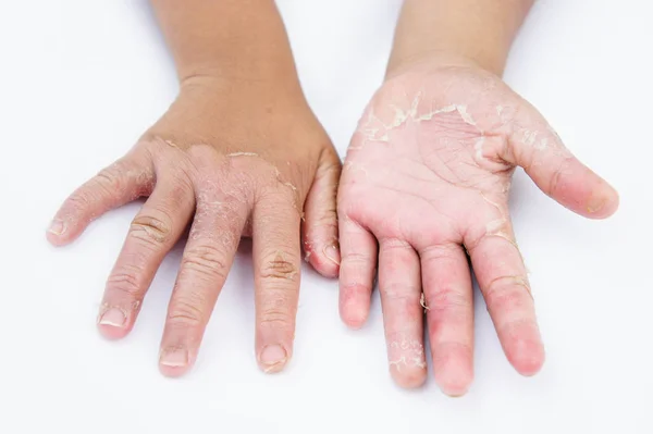 Torka Händerna Peel Kontaktdermatit Svampinfektioner Hudinfektioner Från Exponering — Stockfoto