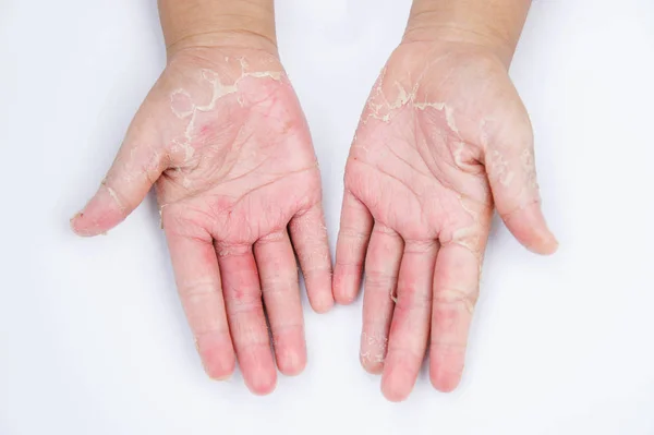 Droge handen, peel, contactdermatitis, schimmelinfecties, huid inf — Stockfoto