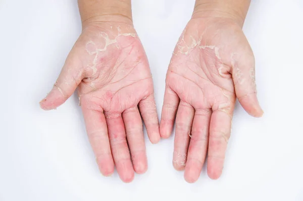 Droge handen, peel, contactdermatitis, schimmelinfecties, huid inf — Stockfoto