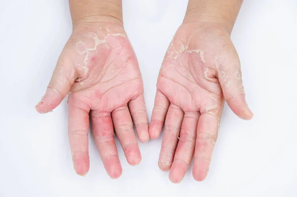 Mãos secas, casca, dermatite de contato, infecções fúngicas, pele inf — Fotografia de Stock