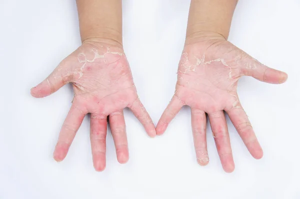 Dry hands, peel, Contact dermatitis, fungal infections, Skin inf