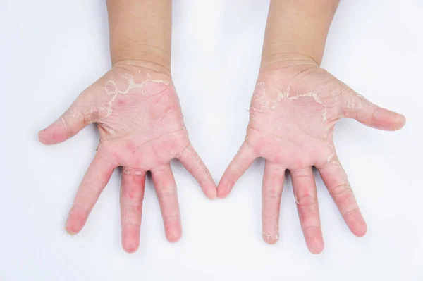 Manos secas, cáscara, dermatitis de contacto, infecciones fúngicas, piel inf —  Fotos de Stock