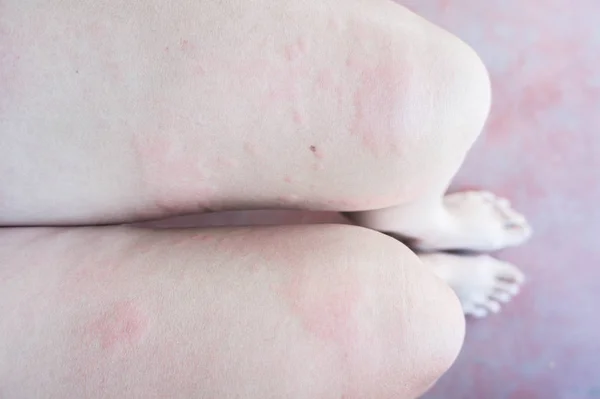 Hautausschlag nach allergischer Infektion, Ekzem-Dermatitis — Stockfoto
