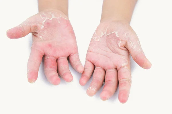 Dermatitis, kinder vingers, huidinfectie, ernstige infectie — Stockfoto