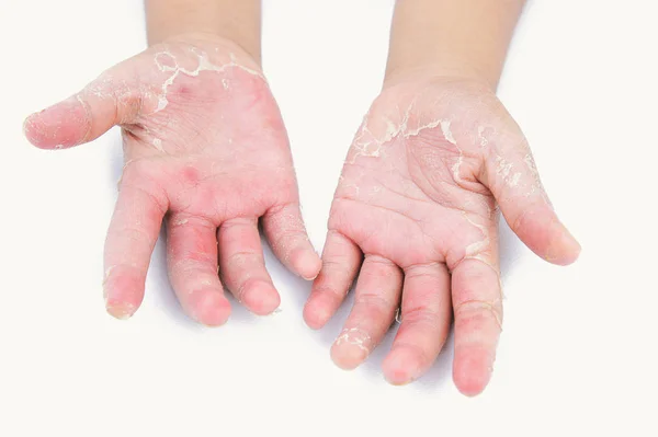 Dermatit, çocuk parmak, deri enfeksiyonu, şiddetli enfeksiyon