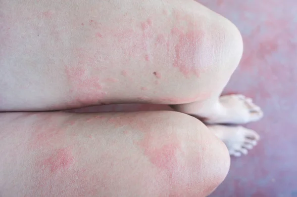Hautausschlag Hautausschlag Aufgrund Allergischer Reaktionen — Stockfoto