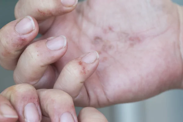 Dermatite nas mãos — Fotografia de Stock