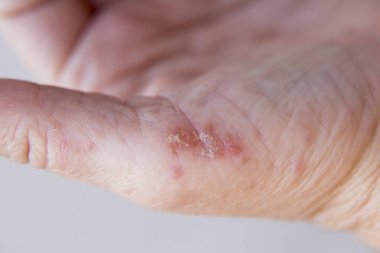 Dermatit elinde