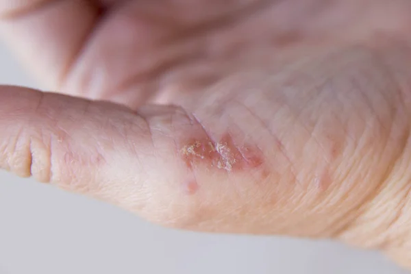 Dermatitis in handen Stockfoto